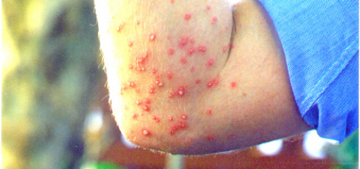 Fire ant sting pustules, 48 hours