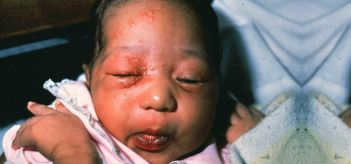 baby with fire ant stings to its face and lips